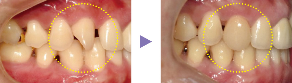 MAZIC Claro CADの症例