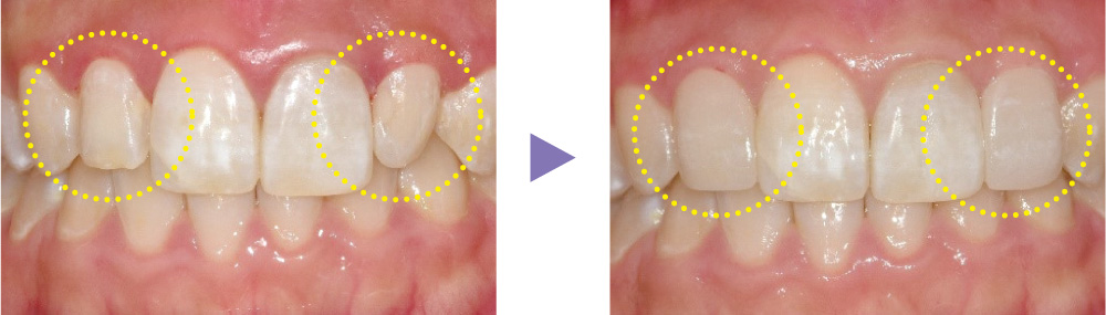MAZIC Claro CADの症例
