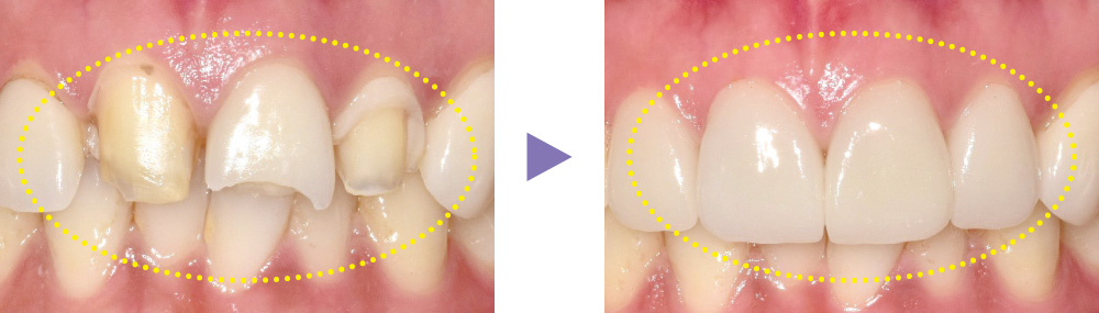 MAZIC Claro CADの症例