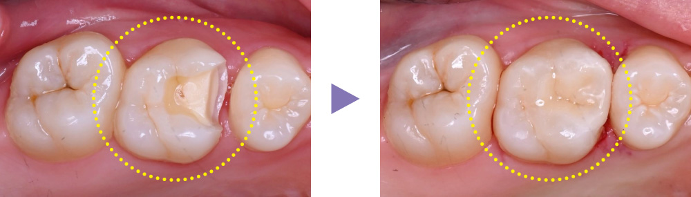 MAZIC Claro CADの症例