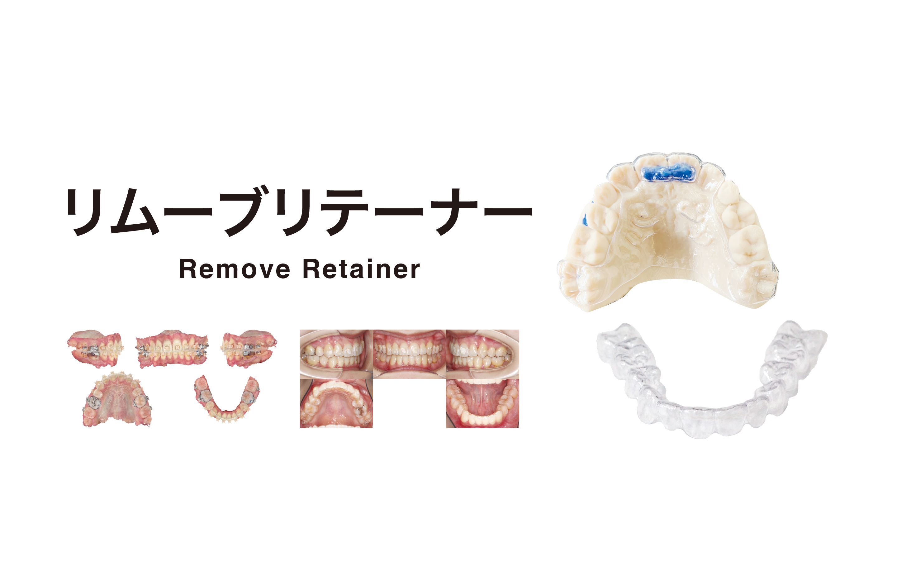 Galaxy クリアリテーナー｜株式会社フォレスト・ワン
