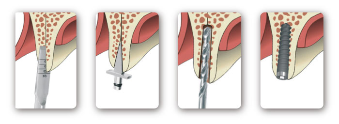  shika_bone splitting system_02