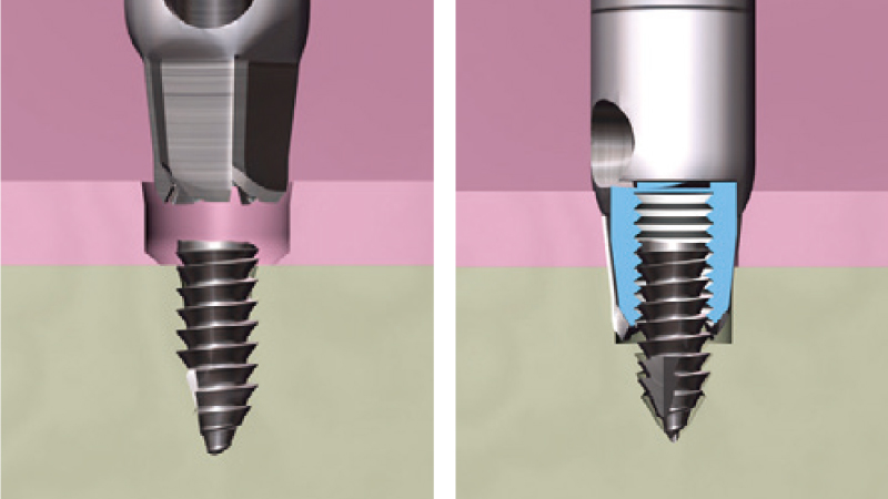 mini-Screw Removerの特徴:確実なスクリュー摘出